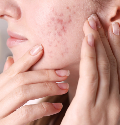 Woman touching face with acne scars