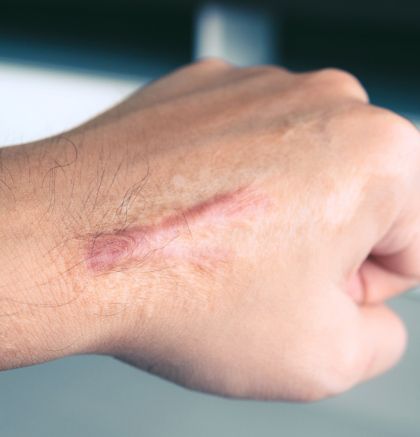 Man holding a fist out with scars on top.