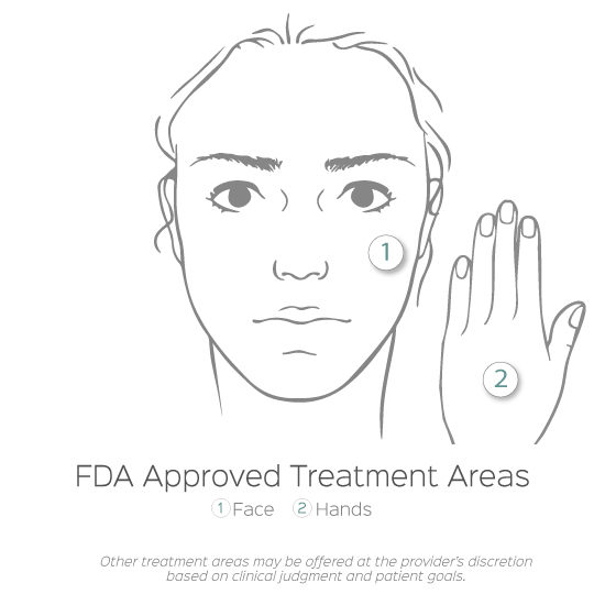 infographic of the fda approved treatment areas of radiesse austin