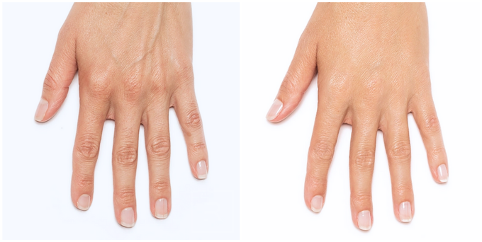 radiesse austin before after
