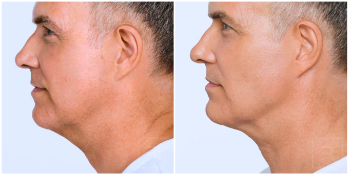radiesse austin before after