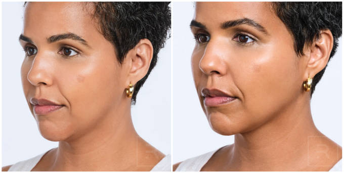 radiesse austin before after