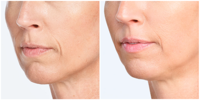 radiesse austin before after