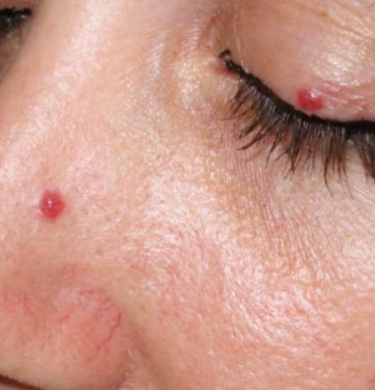 Close-up of cherry angioma on skin – small red vascular growth