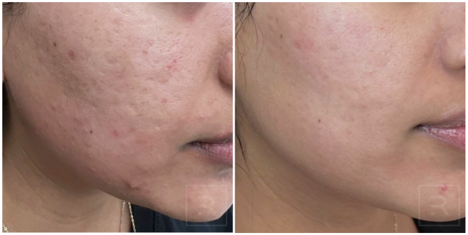 Before and after treatment results – Revelus Dermatology Austin