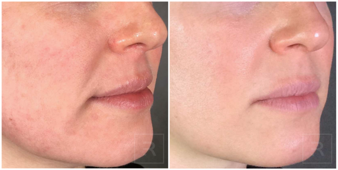 Before and after treatment results – Revelus Dermatology Austin