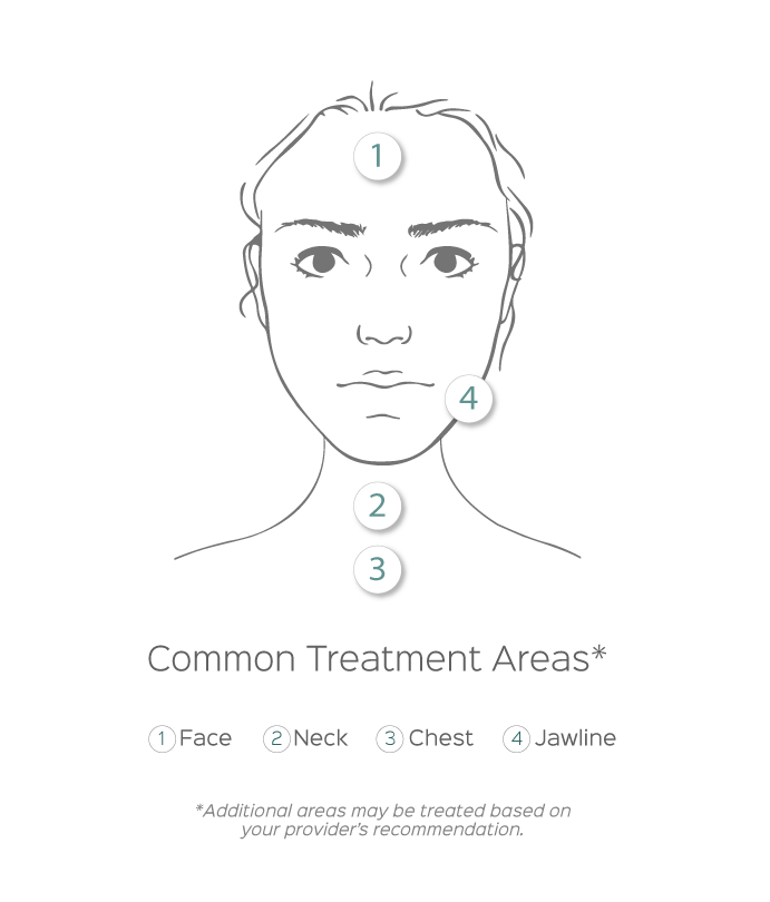 Diagram showing common treatment areas for Secret RF Microneedling on the face, neck, chest, and jawline at Revelus Dermatology Austin