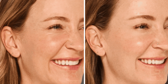 Botox before and after image showing reduction in crow’s feet and expression lines.