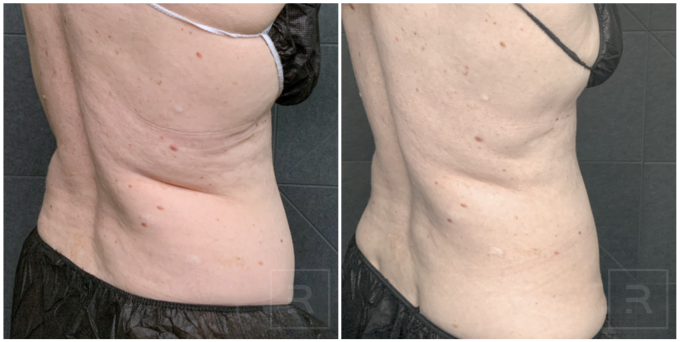 CoolSculpting Elite Flanks before and after at Revelus Dermatology
