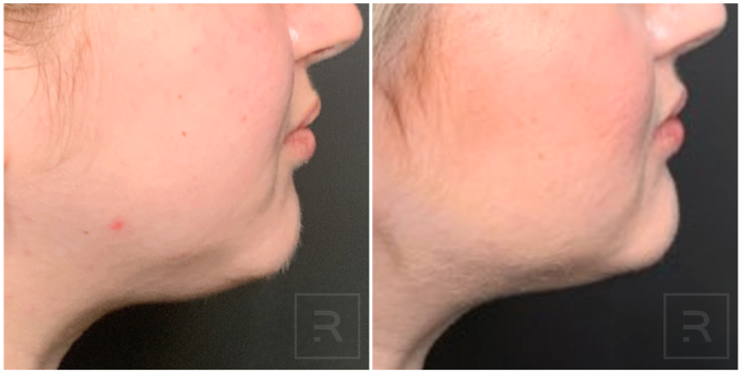 CoolSculpting Elite Submental before and after at Revelus Dermatology