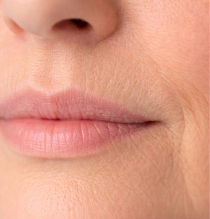 Close-up of lips and surrounding skin showing vertical lip lines.