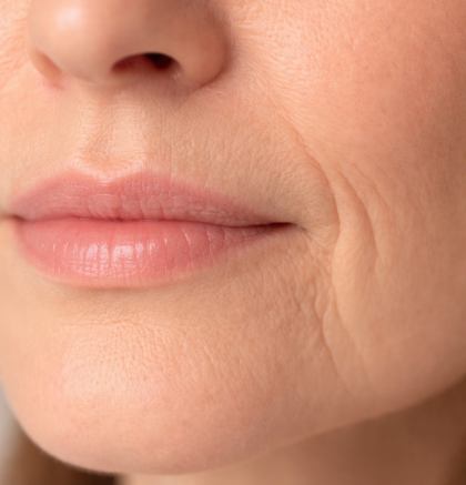 Close-up of lower face showing marionette lines extending from the corners of the mouth toward the chin.
