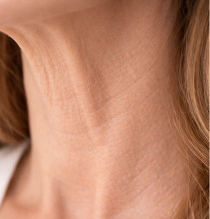 Close-up of neck showing loose skin and mild skin laxity.