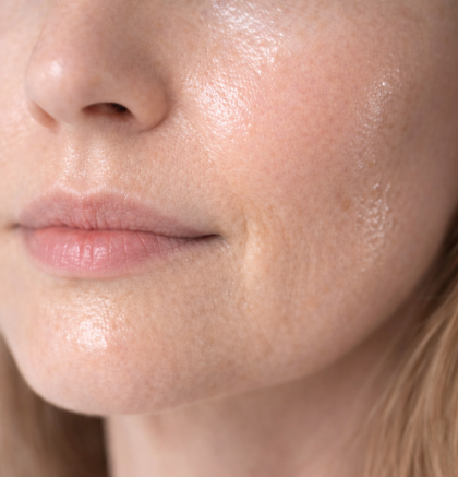 Close-up of lower face showing shiny skin from excess oil.