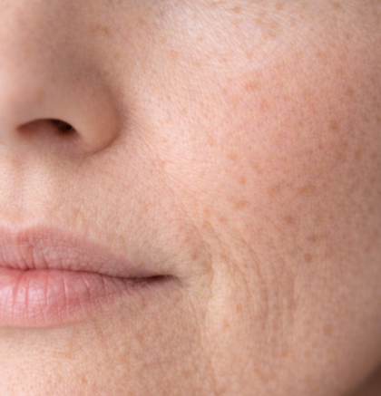 Close-up of cheek and lower face showing uneven skin tone and discoloration.