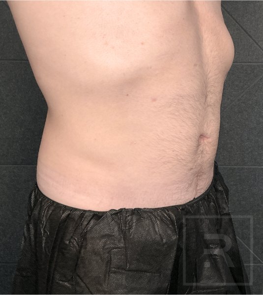 Abdomen and flanks 17 weeks after 2 rounds of CoolSculpting Elite, side view