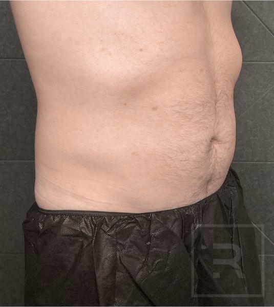 Abdomen and flanks before CoolSculpting Elite, side view